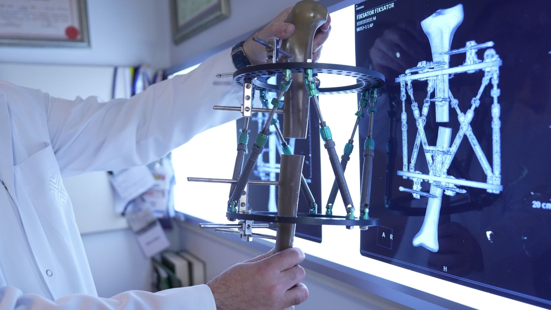 Kemik Uzatma Yöntemlerinde Yeni Dönem Daha Güvenli Ve Konforlu Tedavi (3)