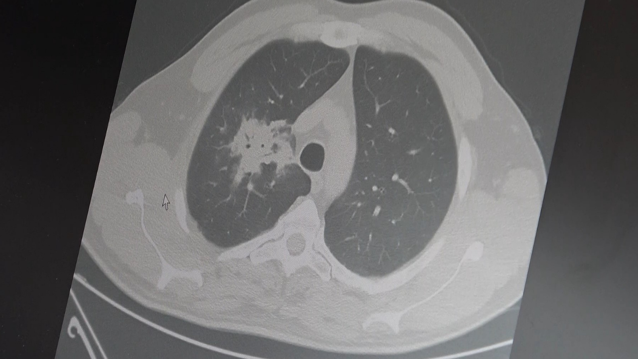 Elektronik sigarada kanser riski bilimsel olarak doğrulandı