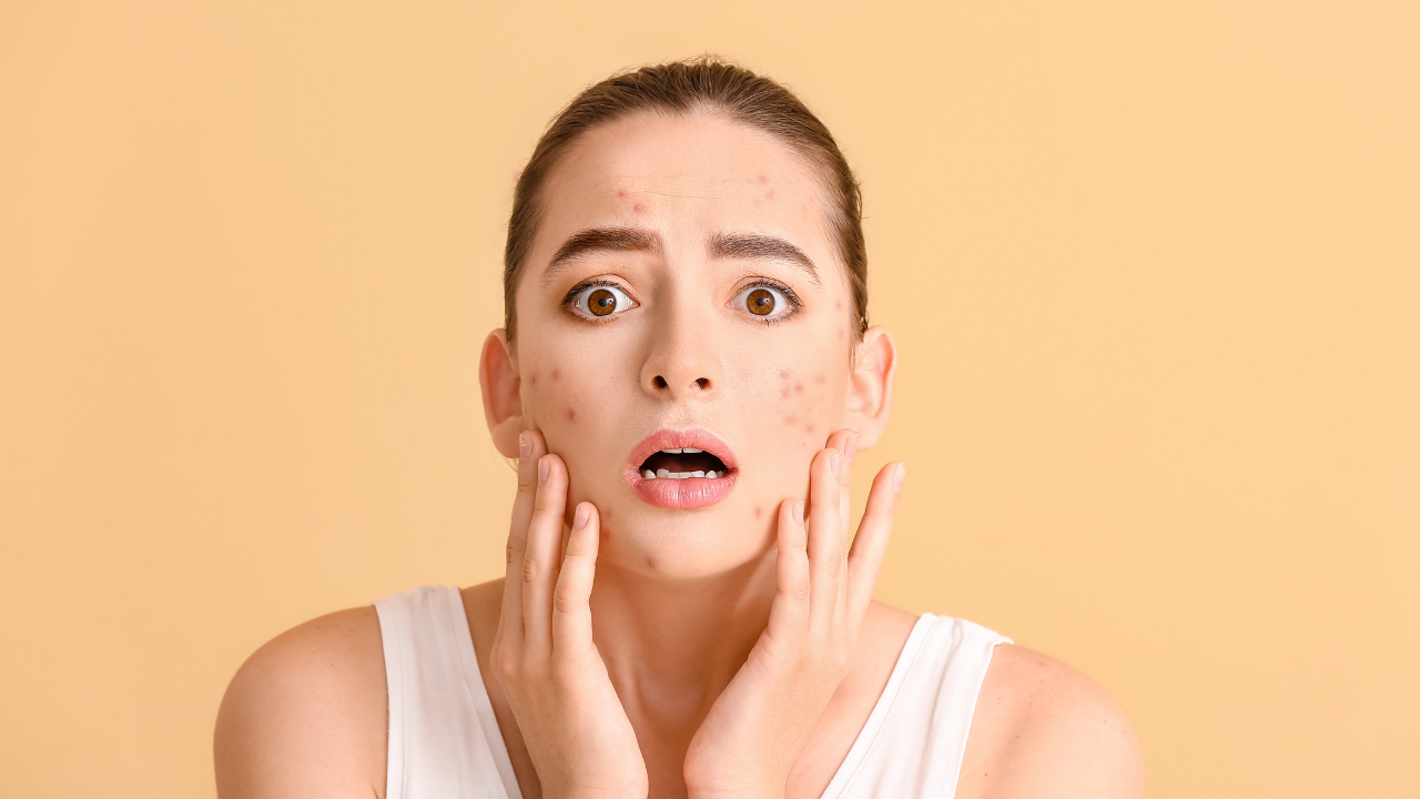 Diyet sivilceyi gerçekten düzeltebilir mi: Dermatologlar ne öneriyor?